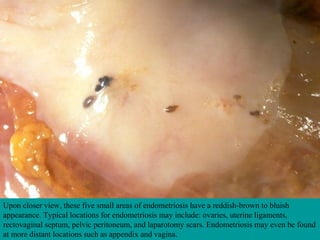 Upon closer view, these five small areas of endometriosis have a reddish-brown to bluish
appearance. Typical locations for endometriosis may include: ovaries, uterine ligaments,
rectovaginal septum, pelvic peritoneum, and laparotomy scars. Endometriosis may even be found
at more distant locations such as appendix and vagina.
 