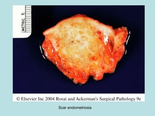 Scar endometriosis
 