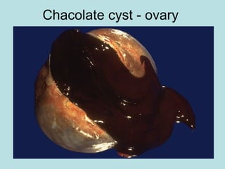 Chacolate cyst - ovary
 