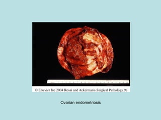 Ovarian endometriosis
 