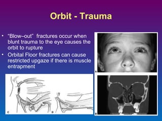 Orbit - Trauma
• “Blow–out” fractures occur when
blunt trauma to the eye causes the
orbit to rupture
• Orbital Floor fractures can cause
restricted upgaze if there is muscle
entrapment

 