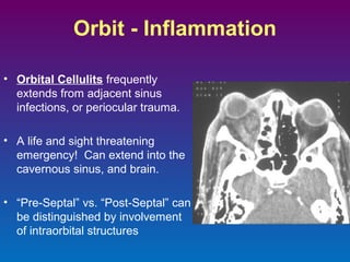 Orbit - Inflammation
• Orbital Cellulits frequently
extends from adjacent sinus
infections, or periocular trauma.
• A life and sight threatening
emergency! Can extend into the
cavernous sinus, and brain.
• “Pre-Septal” vs. “Post-Septal” can
be distinguished by involvement
of intraorbital structures

 