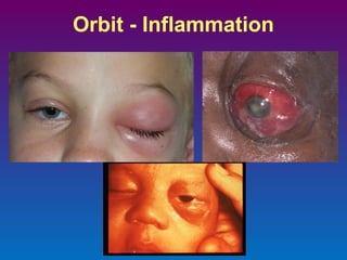 Orbit - Inflammation

 