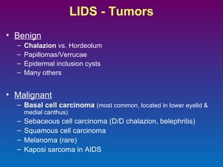 LIDS - Tumors
• Benign
–
–
–
–

Chalazion vs. Hordeolum
Papillomas/Verrucae
Epidermal inclusion cysts
Many others

• Malignant
– Basal cell carcinoma (most common, located in lower eyelid &
medial canthus)

–
–
–
–

Sebaceous cell carcinoma (D/D chalazion, belephritis)
Squamous cell carcinoma
Melanoma (rare)
Kaposi sarcoma in AIDS

 