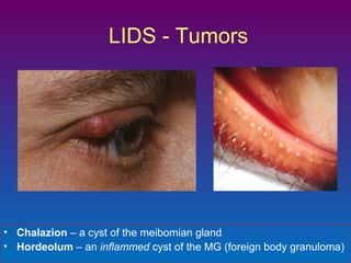 LIDS - Tumors

• Chalazion – a cyst of the meibomian gland
• Hordeolum – an inflammed cyst of the MG (foreign body granuloma)

 
