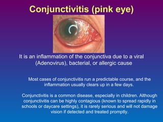 Conjunctivitis (pink eye)

It is an inflammation of the conjunctiva due to a viral
(Adenovirus), bacterial, or allergic cause
Most cases of conjunctivitis run a predictable course, and the
inflammation usually clears up in a few days.
Conjunctivitis is a common disease, especially in children. Although
conjunctivitis can be highly contagious (known to spread rapidly in
schools or daycare settings), it is rarely serious and will not damage
vision if detected and treated promptly.

 
