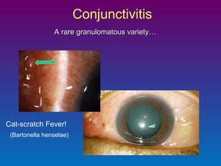 Conjunctivitis
A rare granulomatous variety…

Cat-scratch Fever!
(Bartonella henselae)

 