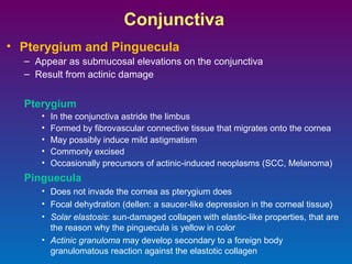 Conjunctiva
• Pterygium and Pinguecula
– Appear as submucosal elevations on the conjunctiva
– Result from actinic damage

Pterygium
•
•
•
•
•

In the conjunctiva astride the limbus
Formed by fibrovascular connective tissue that migrates onto the cornea
May possibly induce mild astigmatism
Commonly excised
Occasionally precursors of actinic-induced neoplasms (SCC, Melanoma)

Pinguecula
• Does not invade the cornea as pterygium does
• Focal dehydration (dellen: a saucer-like depression in the corneal tissue)
• Solar elastosis: sun-damaged collagen with elastic-like properties, that are
the reason why the pinguecula is yellow in color
• Actinic granuloma may develop secondary to a foreign body
granulomatous reaction against the elastotic collagen

 