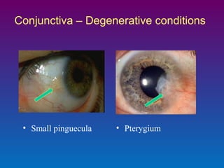 Conjunctiva – Degenerative conditions

• Small pinguecula

• Pterygium

 