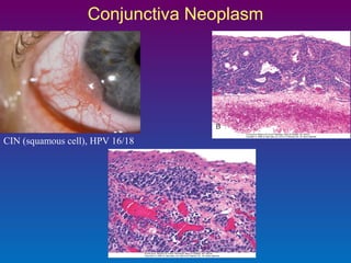 Conjunctiva Neoplasm

CIN (squamous cell), HPV 16/18

 