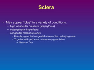 Sclera
• May appear “blue” in a variety of conditions:
– high intraocular pressure (staphyloma)
– osteogenesis imperfecta
– congenital melanosis oculi
• Heavily pigmented congenital nevus of the underlying uvea
• Together with periocular cutaneous pigmentation
– Nevus of Ota

 