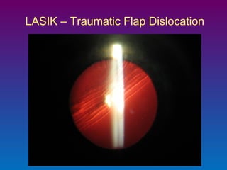 LASIK – Traumatic Flap Dislocation

 