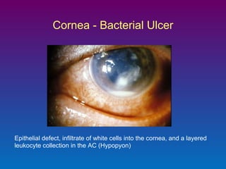 Cornea - Bacterial Ulcer

Epithelial defect, infiltrate of white cells into the cornea, and a layered
leukocyte collection in the AC (Hypopyon)

 