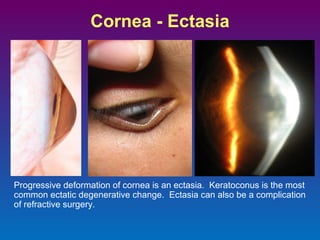 Cornea - Ectasia

Progressive deformation of cornea is an ectasia. Keratoconus is the most
common ectatic degenerative change. Ectasia can also be a complication
of refractive surgery.

 