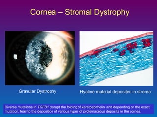 Cornea – Stromal Dystrophy

Granular Dystrophy

Hyaline material deposited in stroma

Diverse mutations in TGFB1 disrupt the folding of keratoepithelin, and depending on the exact
mutation, lead to the deposition of various types of proteinaceous deposits in the cornea.

 
