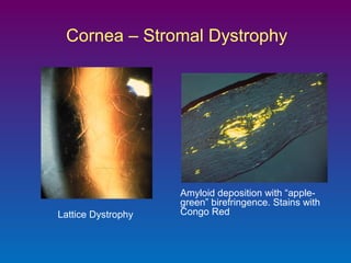 Cornea – Stromal Dystrophy

Lattice Dystrophy

Amyloid deposition with “applegreen” birefringence. Stains with
Congo Red

 