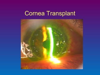 Cornea Transplant

 