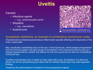 Uveitis
Causes:
• Infectious agents
– e.g.: pneumocystis carinii

• Idiopathic
– e.g.: sarcoidosis

• Autoimmune

Sympathetic ophthalmia

Sympathetic ophthalmia, an example of noninfectious autoimmune uveitis
Characterized by bilateral granulomatous inflammation typically affecting all components of the
uvea: a panuveitis.
May complicate a penetrating injury of the eye. In the injured eye, retinal antigens sequestered
from the immune system may gain access to lymphatics in the conjunctiva and thus set up a
delayed hypersensitivity reaction that affects not only the injured eye but also the contralateral,
noninjured eye.
Condition may develop from 2 weeks to many years after injury. Enucleation of a blind eye
(which can be the sympathizing eye rather than the directly injured eye) may yield diagnostic
findings.
Treated by the administration of systemic immunosuppressive agents.

 