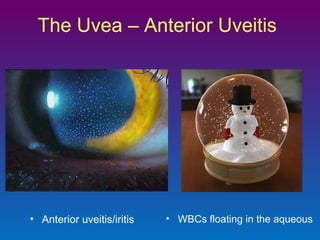 The Uvea – Anterior Uveitis

• Anterior uveitis/iritis

• WBCs floating in the aqueous

 