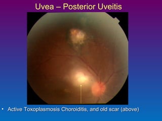 Uvea – Posterior Uveitis

• Active Toxoplasmosis Choroiditis, and old scar (above)

 