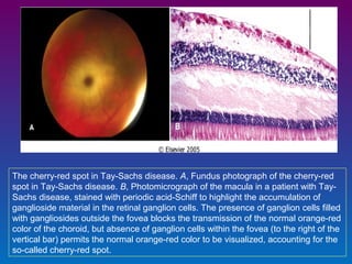 The cherry-red spot in Tay-Sachs disease. A, Fundus photograph of the cherry-red
spot in Tay-Sachs disease. B, Photomicrograph of the macula in a patient with TaySachs disease, stained with periodic acid-Schiff to highlight the accumulation of
ganglioside material in the retinal ganglion cells. The presence of ganglion cells filled
with gangliosides outside the fovea blocks the transmission of the normal orange-red
color of the choroid, but absence of ganglion cells within the fovea (to the right of the
vertical bar) permits the normal orange-red color to be visualized, accounting for the
so-called cherry-red spot.

 