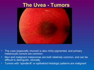 The Uvea - Tumors

• The uvea (especially choroid) is also richly pigmented, and primary
melanocytic tumors are common.
• Nevi and malignant melanomas are both relatively common, and can be
difficult to distinguish, clinically.
• Tumors with “spindle-B” or epithelioid histologic patterns are malignant

 