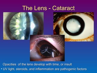 The Lens - Cataract

Opacities of the lens develop with time, or insult
• UV light, steroids, and inflammation are pathogenic factors

 