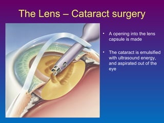The Lens – Cataract surgery
• A opening into the lens
capsule is made
• The cataract is emulsified
with ultrasound energy,
and aspirated out of the
eye

 