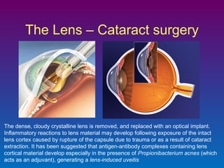 The Lens – Cataract surgery

The dense, cloudy crystalline lens is removed, and replaced with an optical implant.
Inflammatory reactions to lens material may develop following exposure of the intact
lens cortex caused by rupture of the capsule due to trauma or as a result of cataract
extraction. It has been suggested that antigen-antibody complexes containing lens
cortical material develop especially in the presence of Propionibacterium acnes (which
acts as an adjuvant), generating a lens-induced uveitis

 