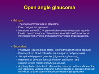 Open angle glaucoma
• Primary
– The most common form of glaucoma
– Few changes are apparent
– Mutations in the GLC1A gene which encodes the protein myocilin
located on chromosome 1 have been associated with a subset of
individuals with juvenile and adult primary open-angle glaucoma.

• Secondary
–
–
–
–
–
–

Phacolysis (liquefied lens cortex, leaking through the lens capsule)
Senescent red blood cells after trauma (ghost cell glaucoma)
iris epithelial pigment granules (pigmentary glaucoma),
fragments of oxytalan fibers (exfoliation glaucoma), and
necrotic tumors (melanomalytic glaucoma) .
Anything that contributes to elevate the pressure on the surface of the
eye (episcleral venous pressure) in the presence of an open angle can
contribute to other types of secondary open angle glaucoma

 