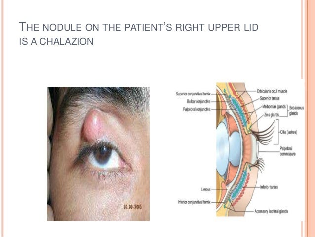 Pathology Of Eye Lids And Adnexa