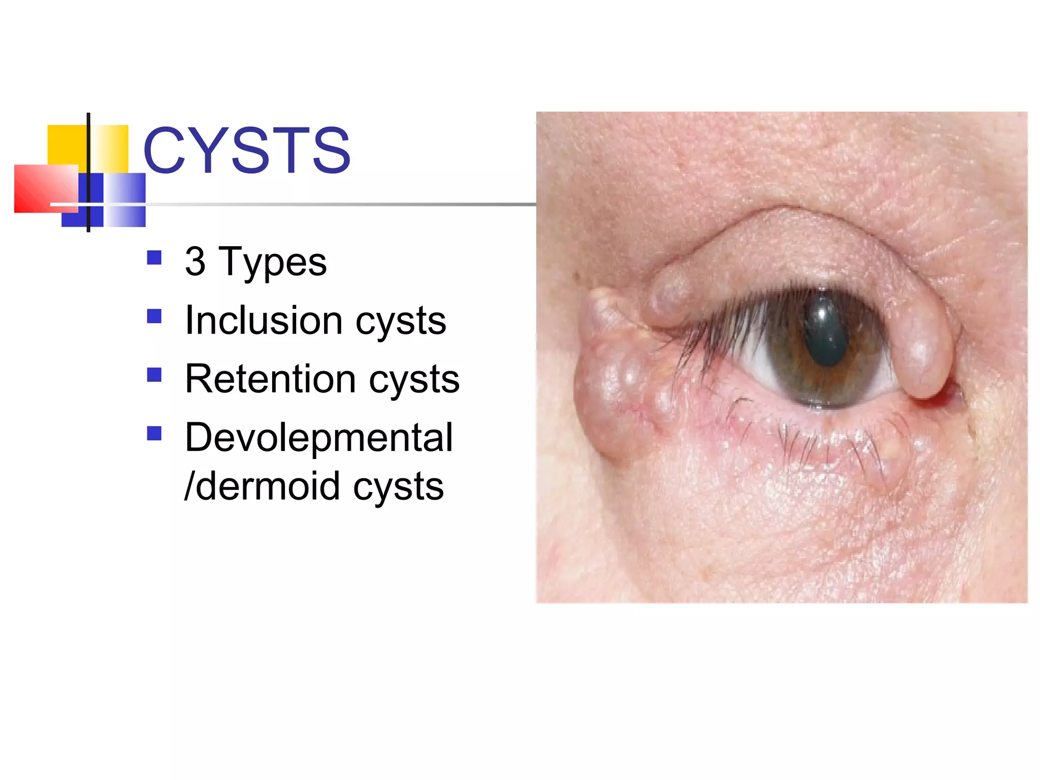 Inclusion Cysts Eyelid