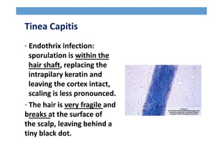 Tinea Capitis
• Endothrix infection:
sporulation is within the
hair shaft, replacing the
intrapilary keratin and
leaving the cortex intact,
scaling is less pronounced.
• The hair is very fragile and
breaks at the surface of
the scalp, leaving behind a
tiny black dot.
 