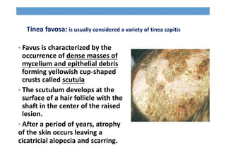 Tinea favosa: is usually considered a variety of tinea capitis
• Favus is characterized by the
occurrence of dense masses of
mycelium and epithelial debris
forming yellowish cup-shaped
crusts called scutula
• The scutulum develops at the
surface of a hair follicle with the
shaft in the center of the raised
lesion.
• After a period of years, atrophy
of the skin occurs leaving a
cicatricial alopecia and scarring.
 
