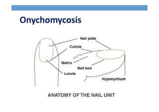 Onychomycosis
 
