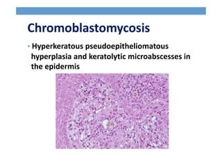 Chromoblastomycosis
• Hyperkeratous pseudoepitheliomatous
hyperplasia and keratolytic microabscesses in
the epidermis
 