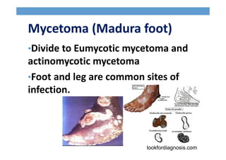Mycetoma (Madura foot)
•Divide to Eumycotic mycetoma and
actinomycotic mycetoma
•Foot and leg are common sites of
infection.
lookfordiagnosis.com
 
