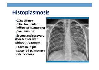 Histoplasmosis
• CXR: diffuse
reticulonodular
infiltrates suggesting
pneumonitis,
• Severe and recovery
slow but recover
without treatment
• Leave multiple
scattered pulmonary
calcifications
 