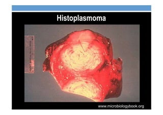 Histoplasmoma
www.microbiologybook.org
 
