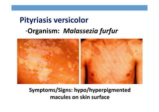 Pityriasis versicolor
•Organism: Malassezia furfur
Symptoms/Signs: hypo/hyperpigmented
macules on skin surface
 