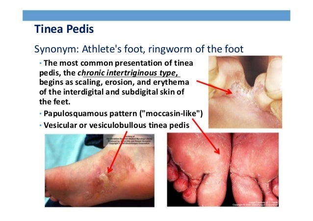 Pathology of fungal infection
