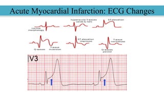 Atrial Infarction Pathology of heart | PPTX