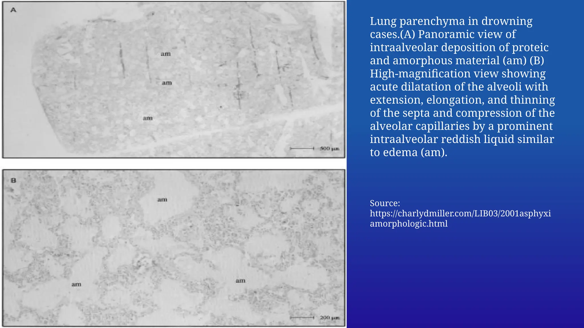 Pathology of mechanical asphyxia - a brief overview | PPTX