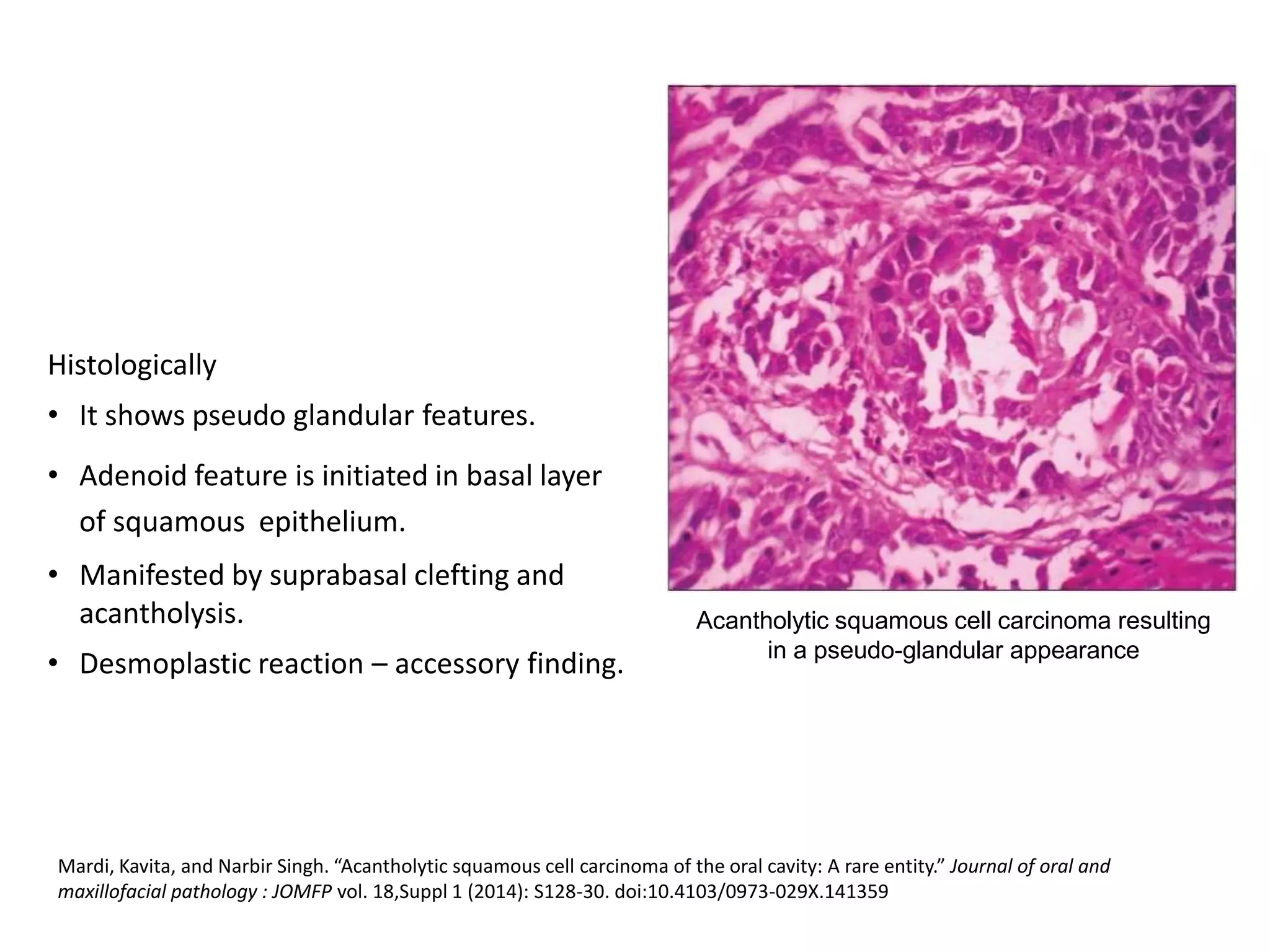 Pathology of oral cancer | PPTX
