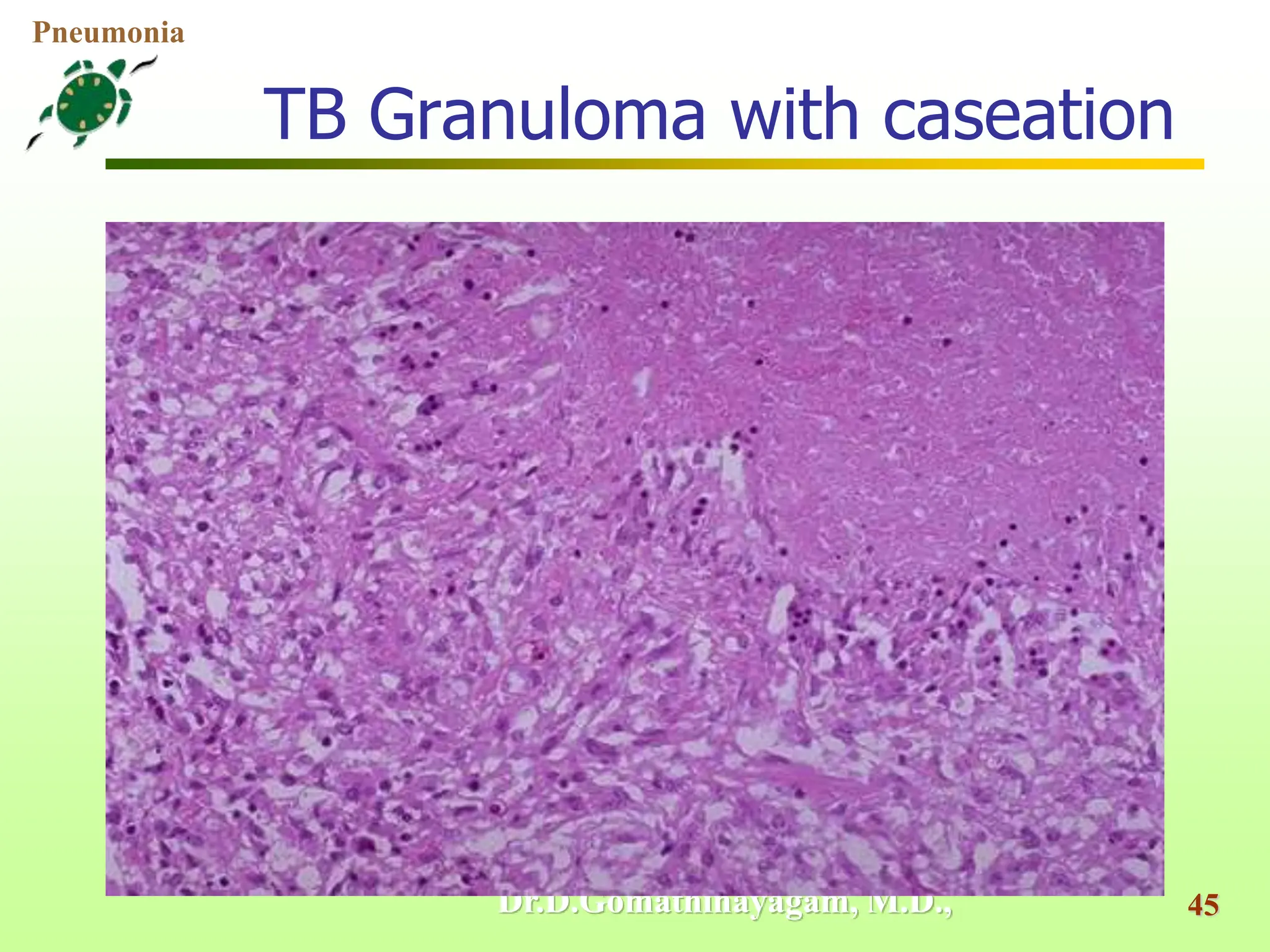 Caseation Hitopath Pathology of Pneumonia POWERPOINT PRESENTATION | PPT