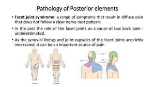 Pathology of Posterior elements
• Facet joint syndrome: a range of symptoms that result in diffuse pain
that does not follow a clear nerve root pattern.
• In the past the role of the facet joints as a cause of low back pain -
underestimated.
• As the synovial linings and joint capsules of the facet joints are richly
innervated, it can be an important source of pain.
 