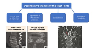 Degenerative changes of the facet joints
vacuum joint
phenomenon
hypertrophy of
the articular
processes
osteosclerosis
osteophyte
formation
 