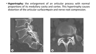 • Hypertrophy: the enlargement of an articular process with normal
proportions of its medullary cavity and cortex. This hypertrophy causes
distortion of the articular surface⇒pain and nerve root compression.
 