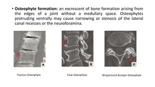 • Osteophyte formation: an excrescent of bone formation arising from
the edges of a joint without a medullary space. Osteophytes
protruding ventrally may cause narrowing or stenosis of the lateral
canal recesses or the neuroforamina.
Traction Osteophyte Claw Osteophyte Wraparound Bumper Osteophyte
 