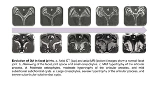 Evolution of OA in facet joints. a, Axial CT (top) and axial MR (bottom) images show a normal facet
joint. b, Narrowing of the facet joint space and small osteophytes. c, Mild hypertrophy of the articular
process. d, Moderate osteophytes, moderate hypertrophy of the articular process, and mild
subarticular subchondral cysts. e, Large osteophytes, severe hypertrophy of the articular process, and
severe subarticular subchondral cysts.
 